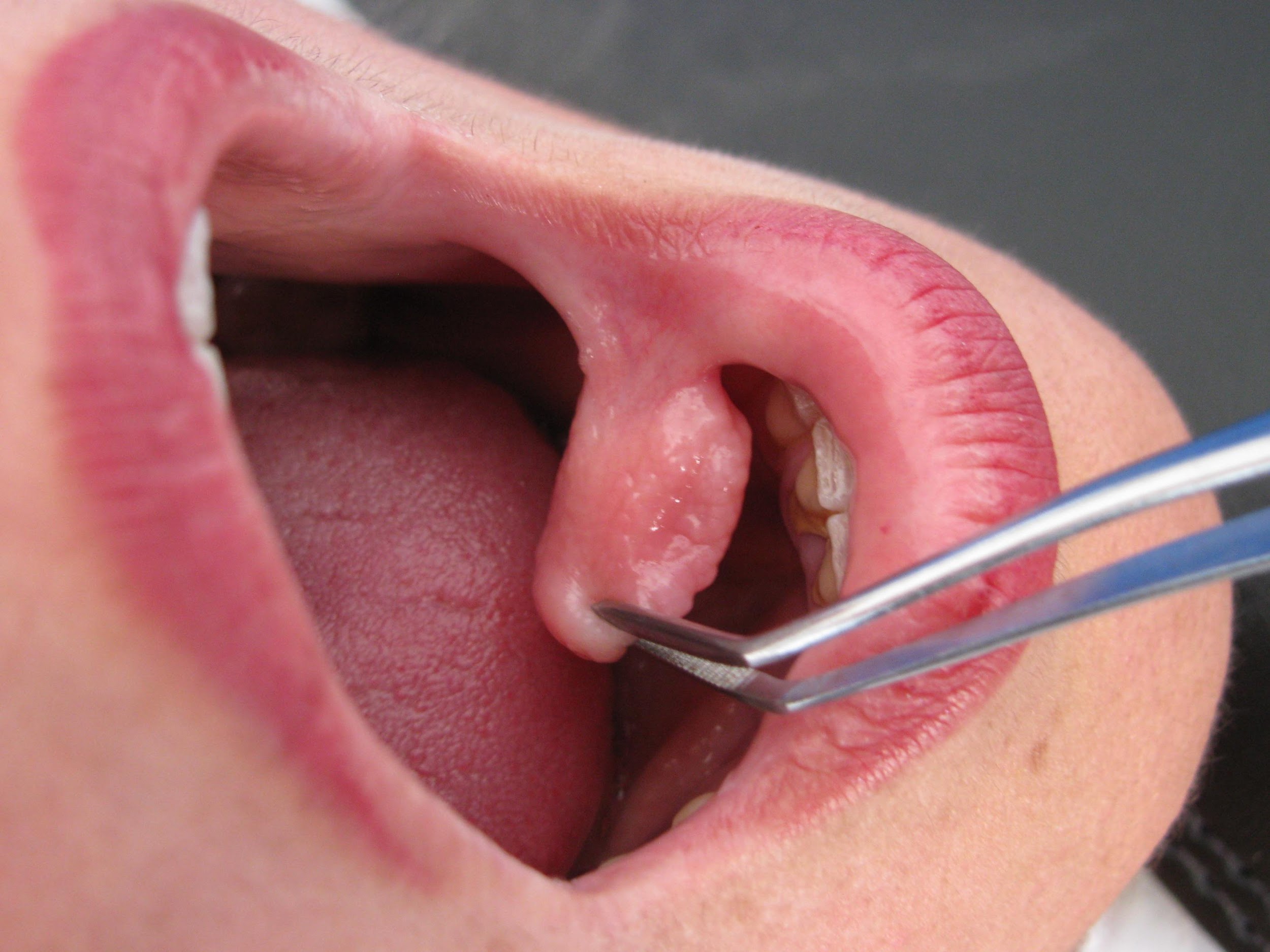 Excéresis de Fibroma irritativo. Laser Diodo