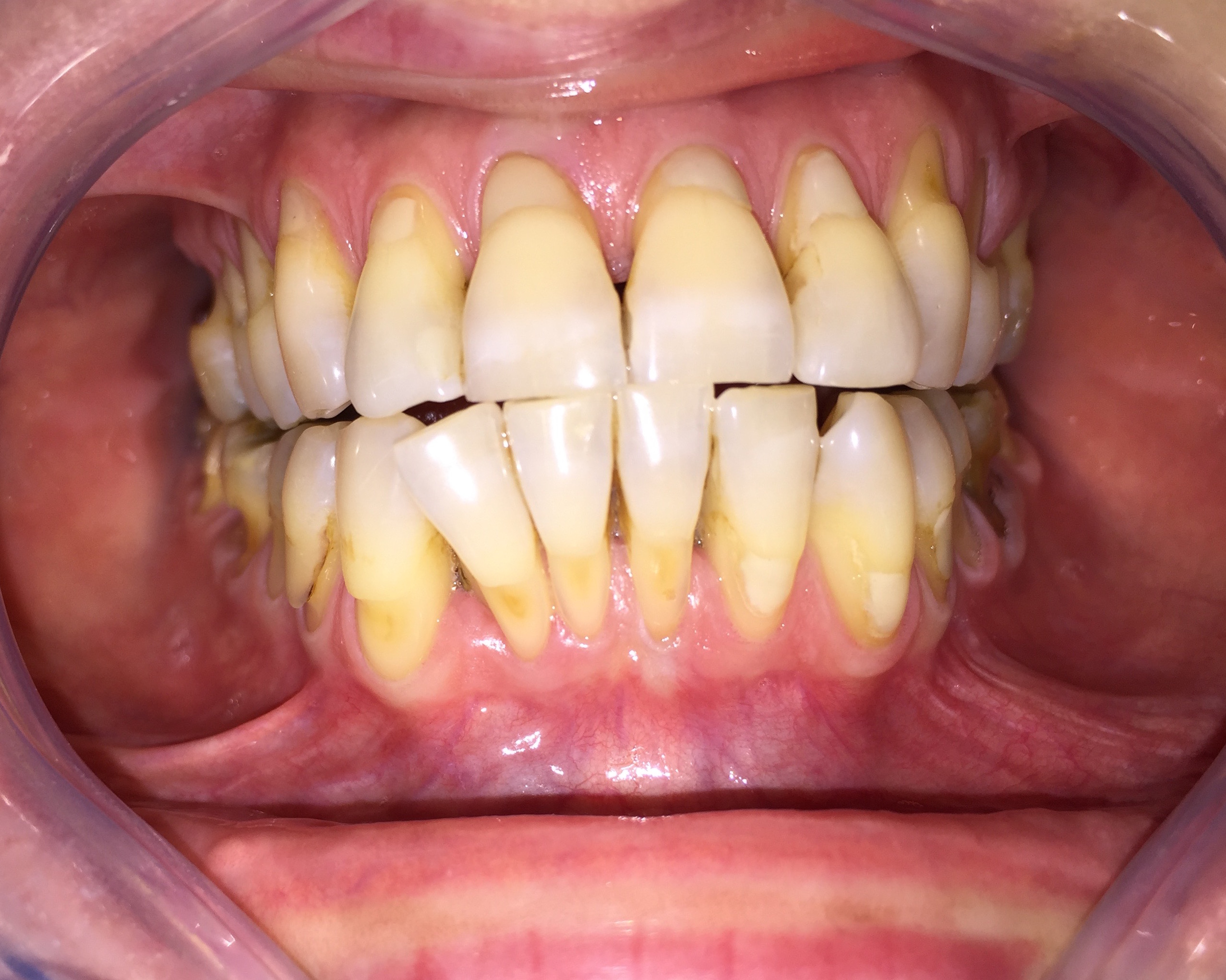 Desensibilizacion dentinaria de lesiones no cariosas extensas (abfracciones)