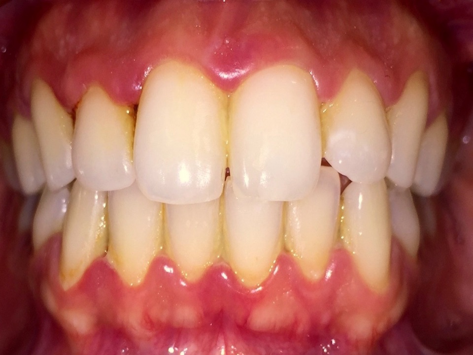 Gingivitis Ulceronecrótica